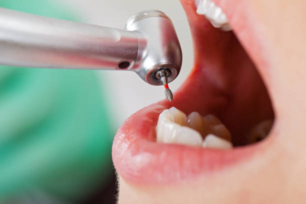 Best Emergency Dentist for Lost Fillings or Crowns in Petersburg, MI